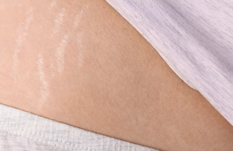 Does Aloe Vera Help Remove Stretch Marks?